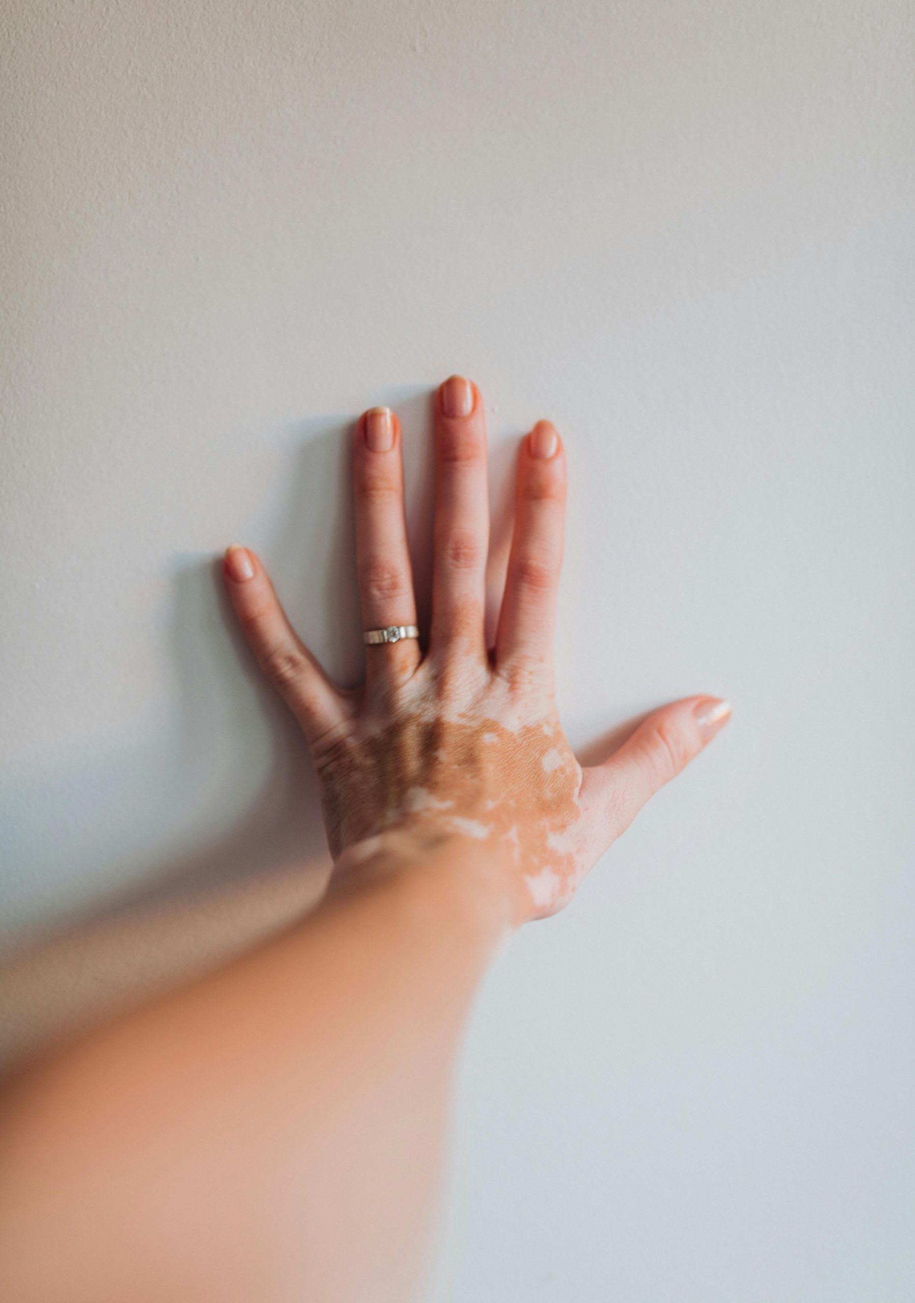 A hand with a skin condition pressed against a wall showcasing unique pigmentation.